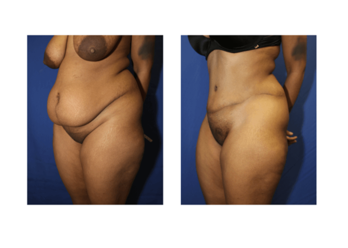 before and after